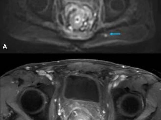 MRI CT PET Scans - Adenocarcinoma 3T v 1.5T