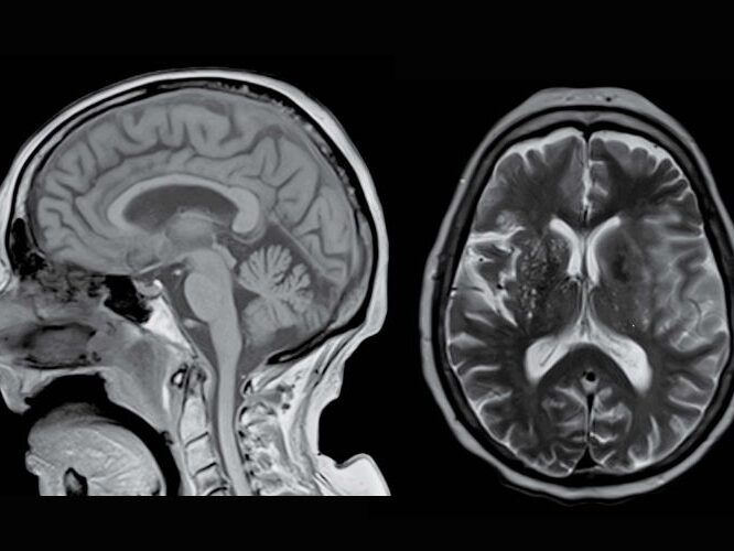 MRI Neurosurgery Diagnostic Imaging