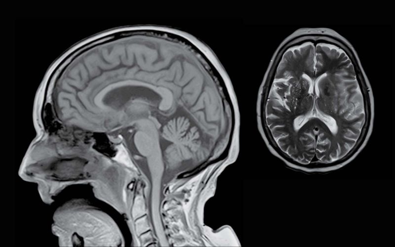 MRI Neurosurgery Diagnostic Imaging